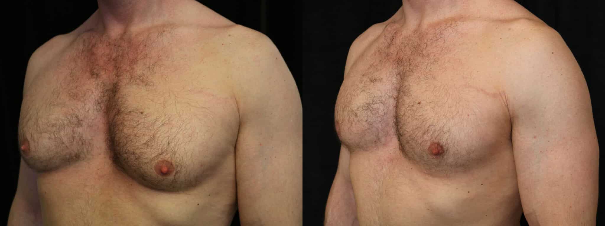 Gynecomastia Patient 2 Before & After Details