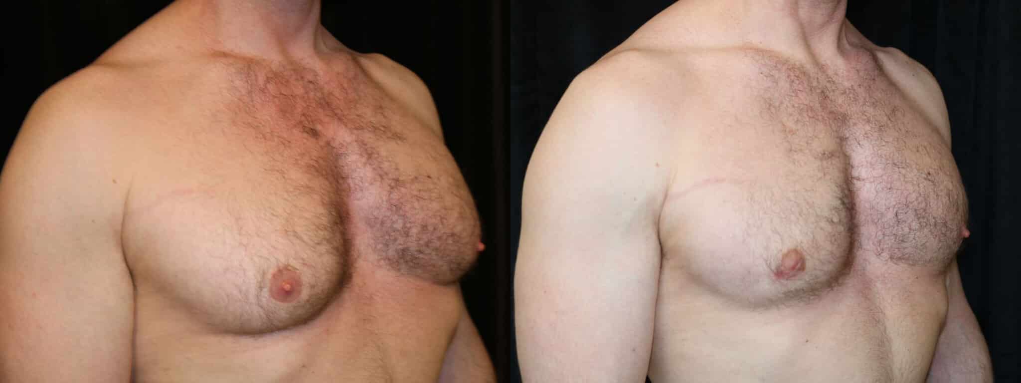 Gynecomastia Patient 2 Before & After Details