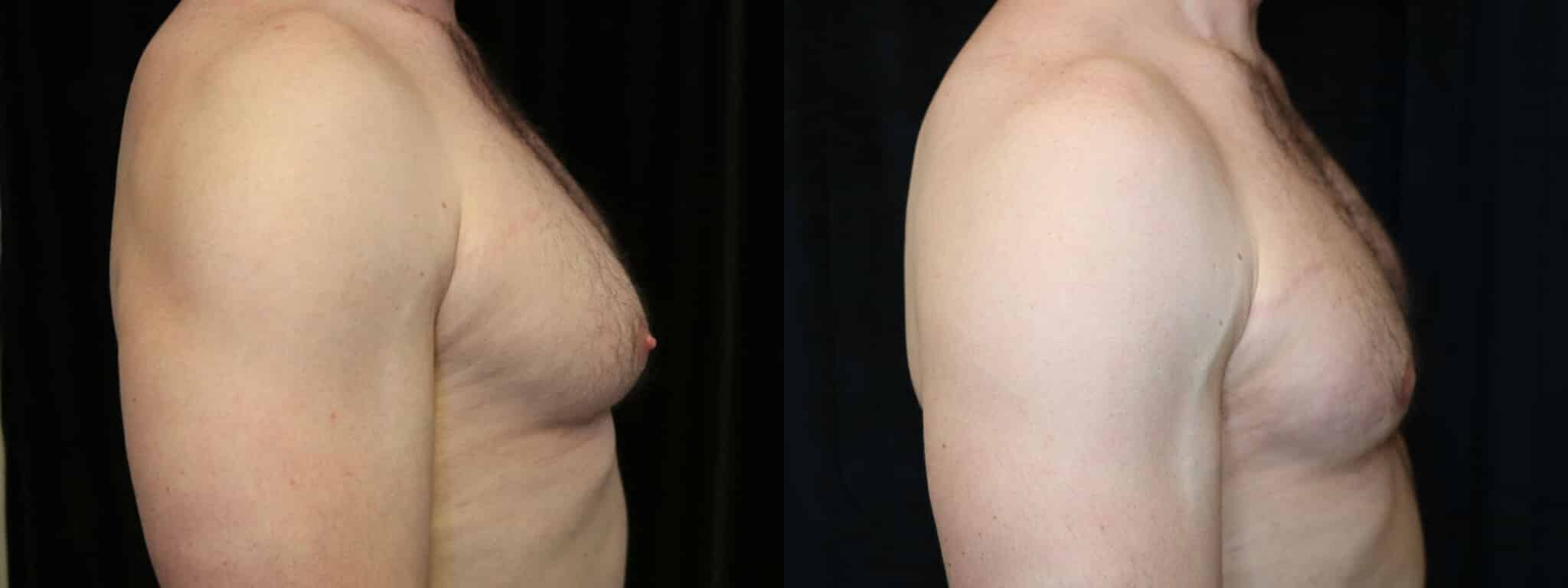 Gynecomastia Patient 2 Before & After Details