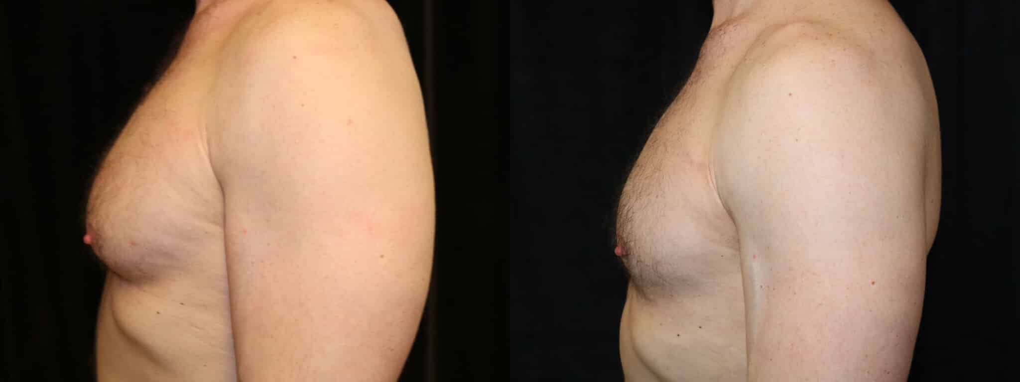 Gynecomastia Patient 2 Before & After Details