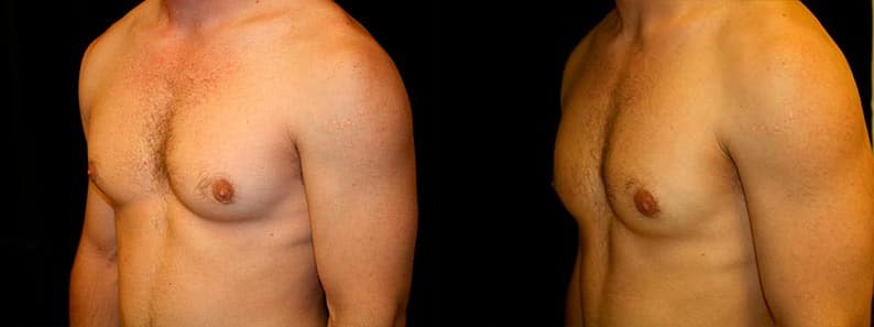 Gynecomastia Patient 9 Before & After Details