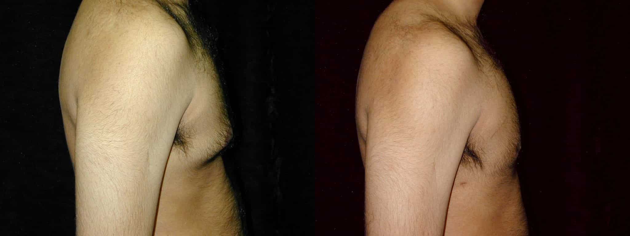 Gynecomastia Patient 10 Before & After Details