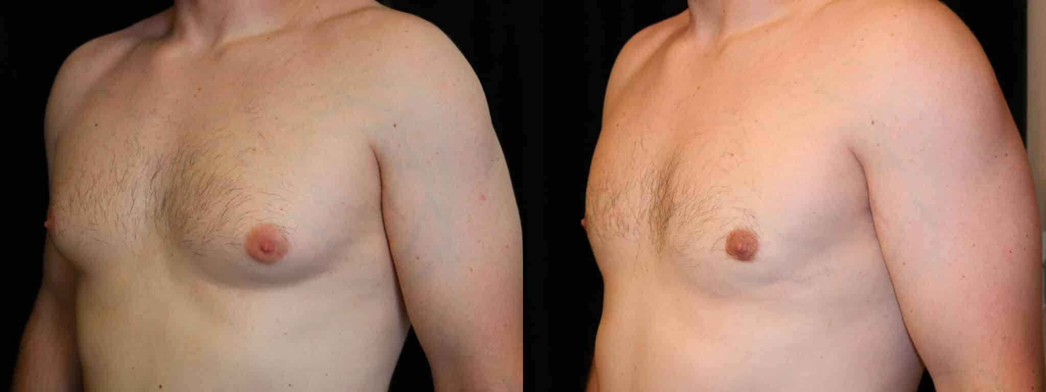 Gynecomastia Patient 5 Before & After Details