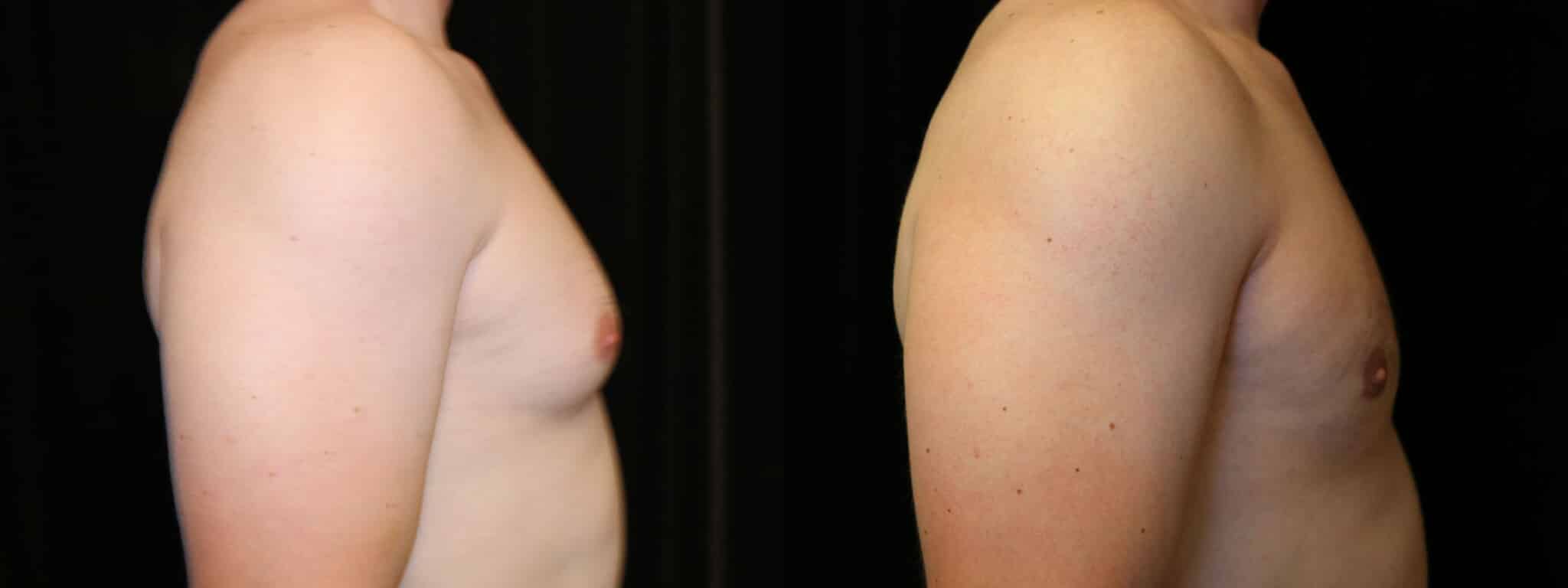 Gynecomastia Patient 5 Before & After Details