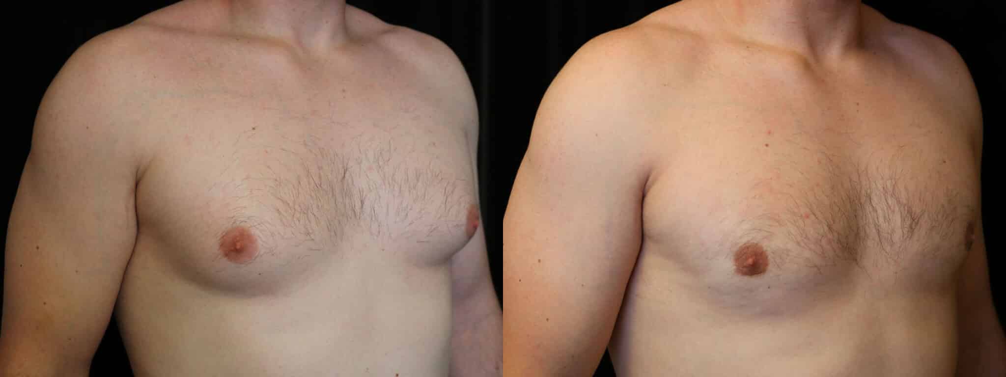 Gynecomastia Patient 5 Before & After Details