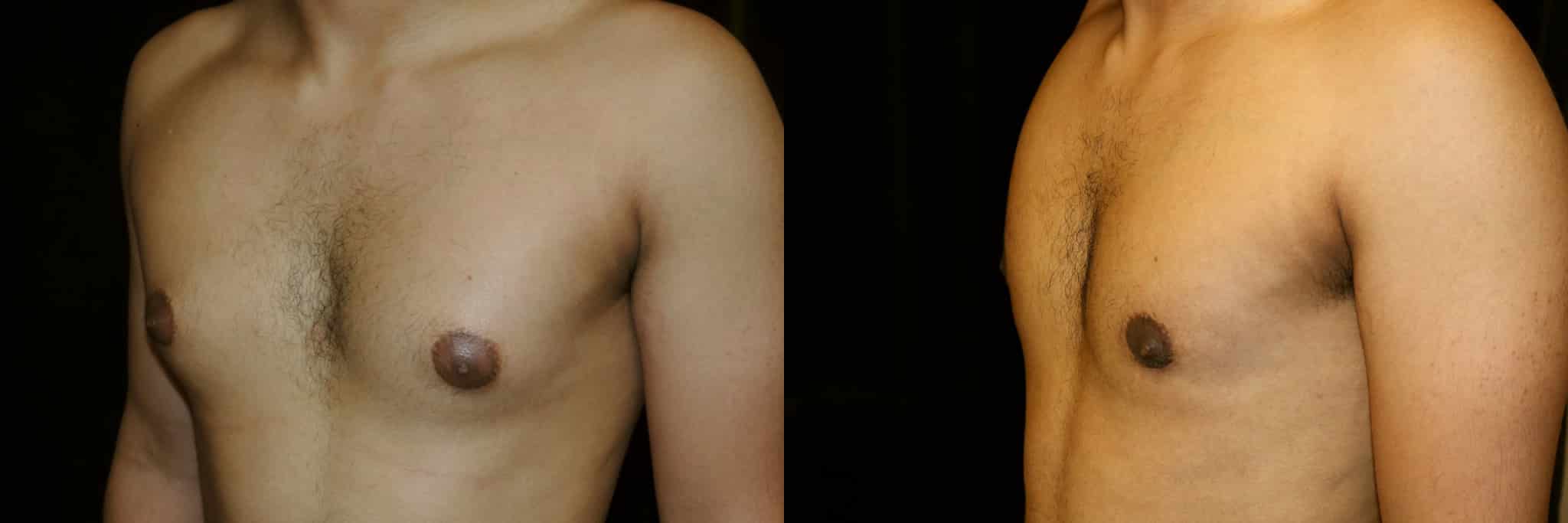 Gynecomastia Patient 16 Before & After Details