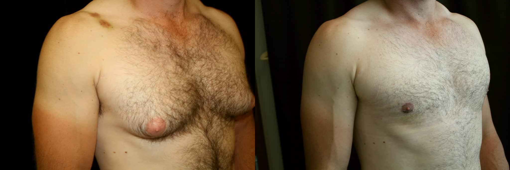 Gynecomastia Patient 2 Before & After Details