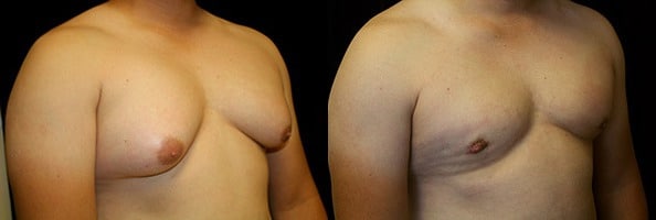 Gynecomastia Patient 8 Before & After Details