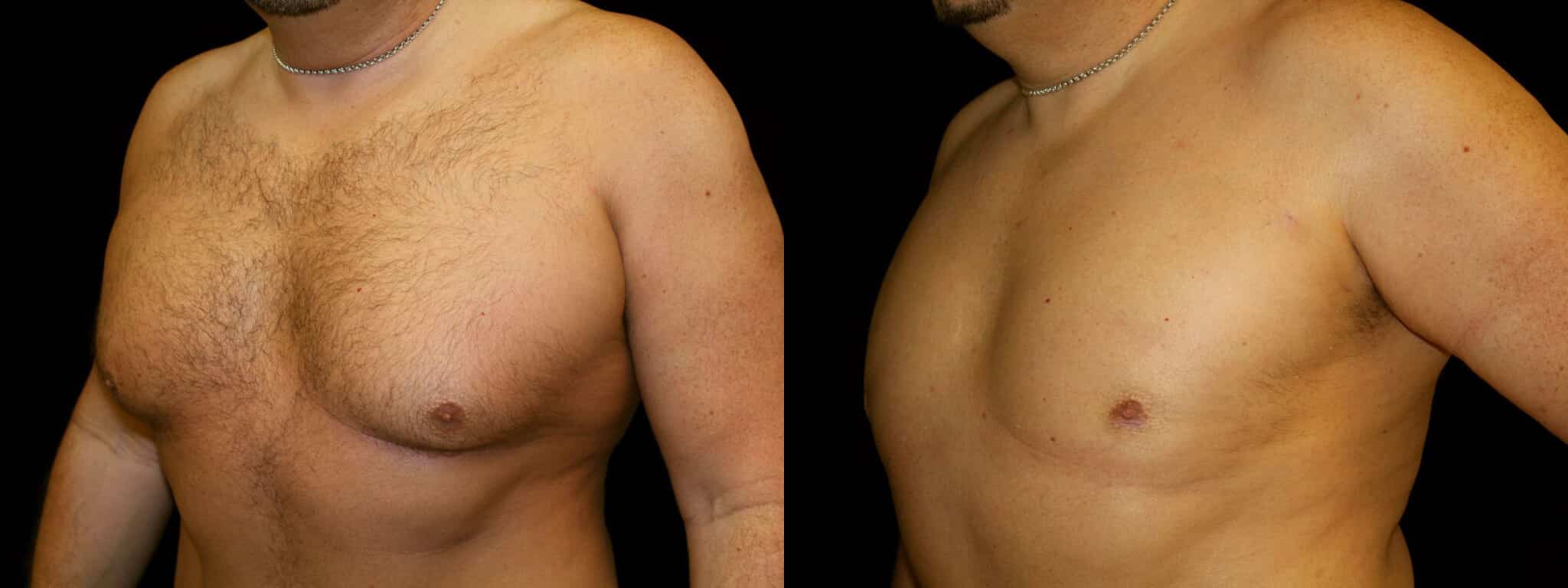 Gynecomastia Patient 19 Before & After Details