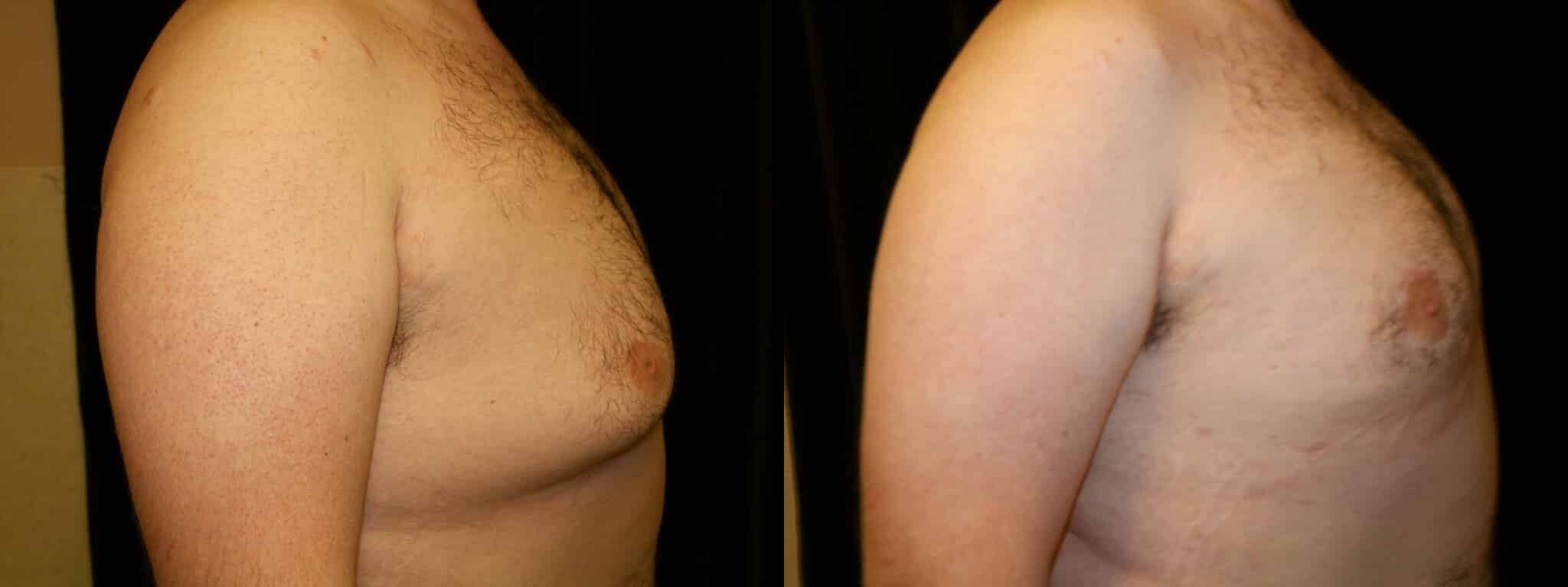 Gynecomastia Patient 14 Before & After Details