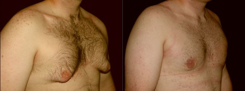 Gynecomastia Patient 14 Before & After Details