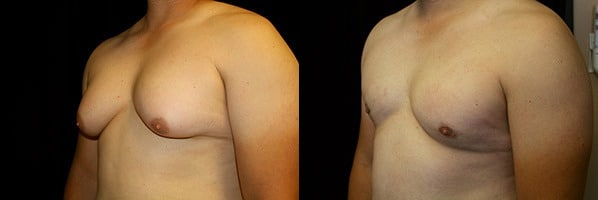 Gynecomastia Patient 8 Before & After Details