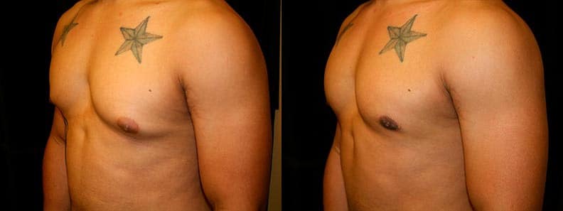 Gynecomastia Patient 16 Before & After Details