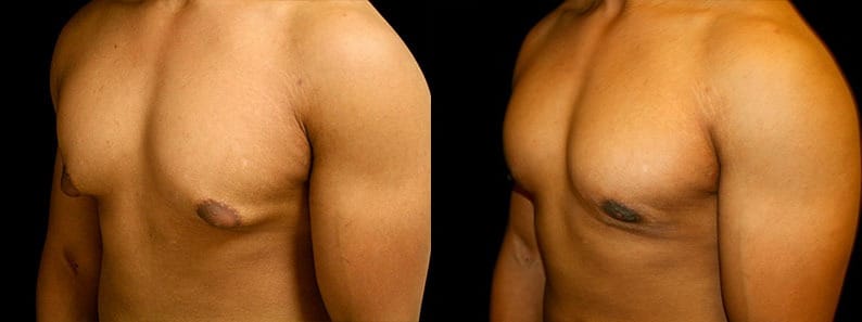 Gynecomastia Patient 1 Before & After Details