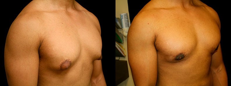 Gynecomastia Patient 1 Before & After Details