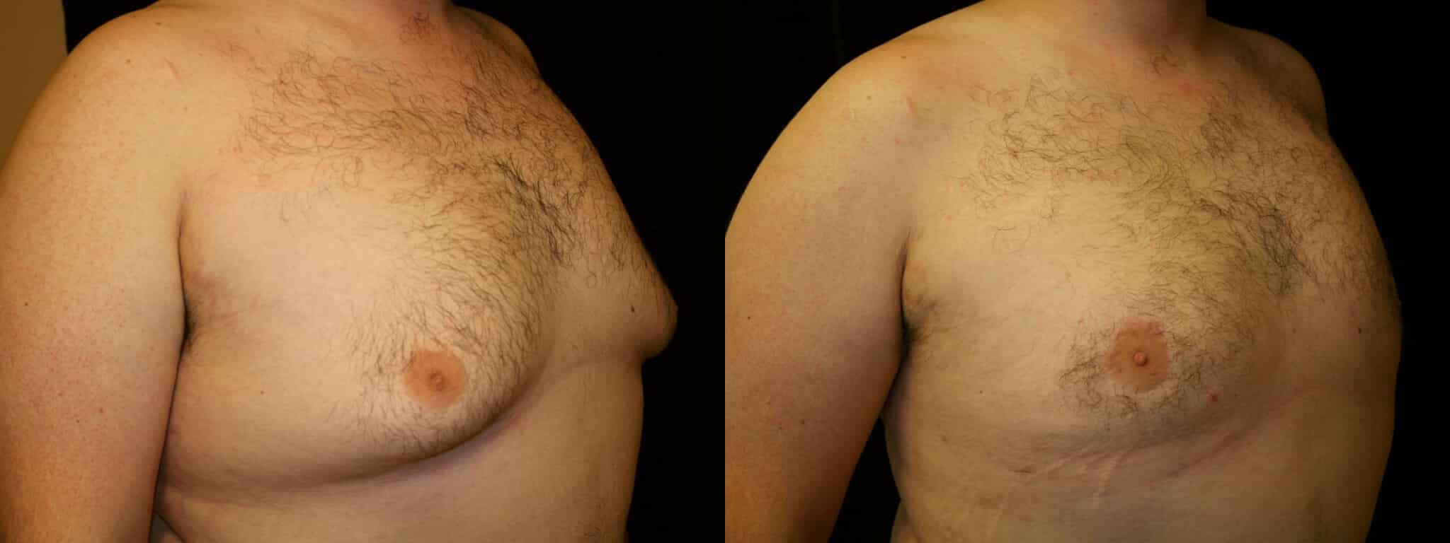 Gynecomastia Patient 14 Before & After Details