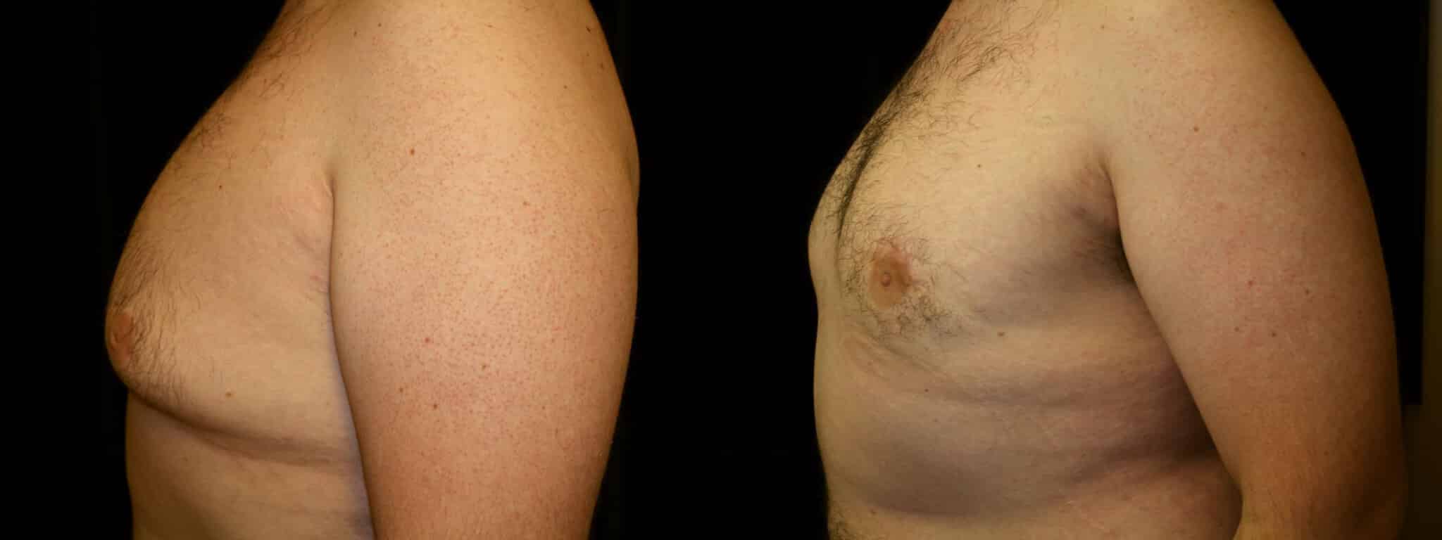 Gynecomastia Patient 14 Before & After Details