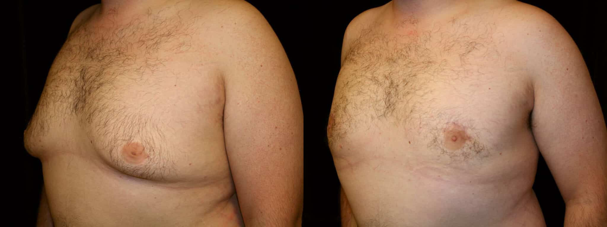 Gynecomastia Patient 14 Before & After Details