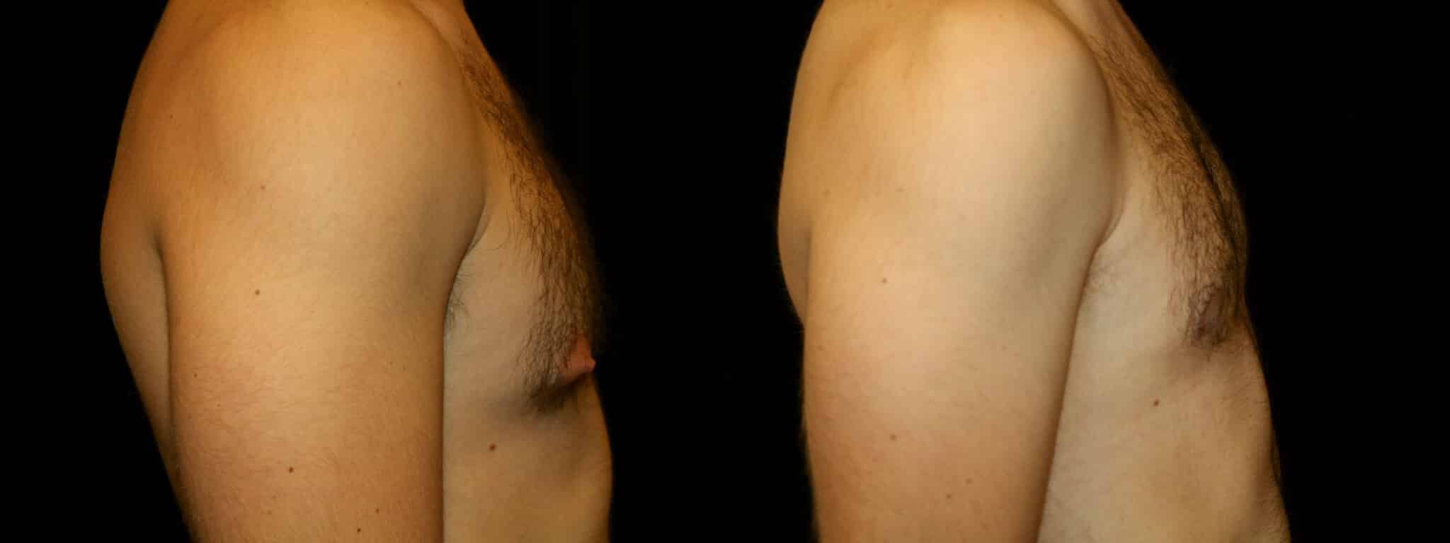 Gynecomastia Patient 5 Before & After Details