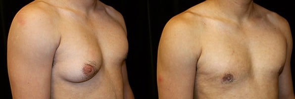 Gynecomastia Patient 21 Before & After Details