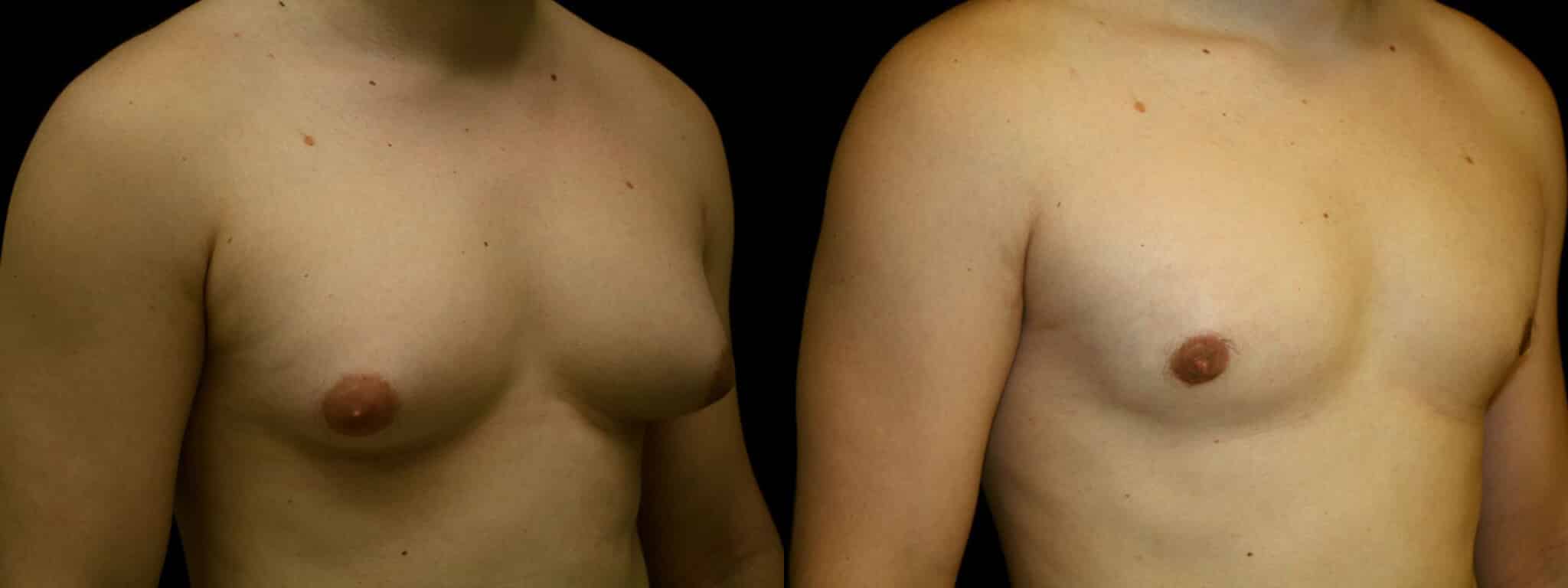 Gynecomastia Patient 12 Before & After Details