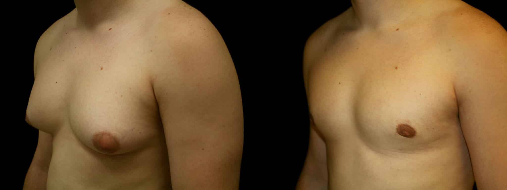 Gynecomastia Patient 12 Before & After Details