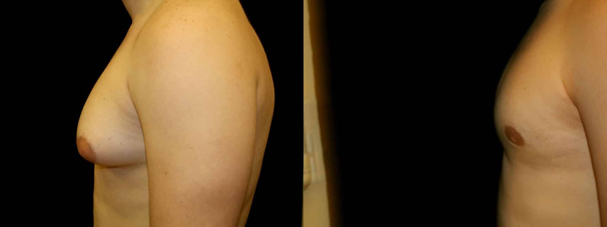 Gynecomastia Patient 12 Before & After Details