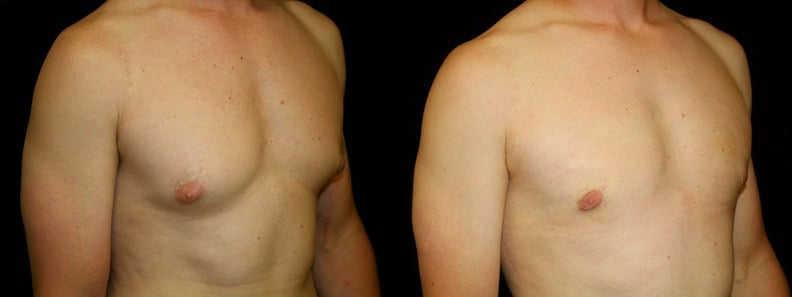 Gynecomastia Patient 4 Before & After Details