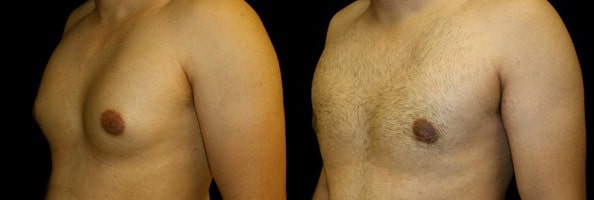 Gynecomastia Patient 3 Before & After Details