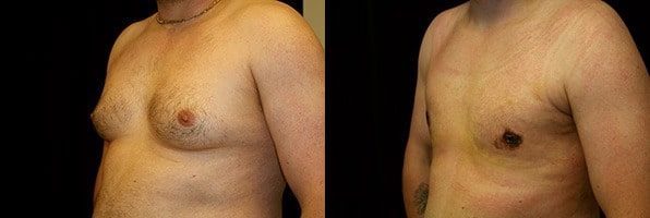 Gynecomastia Patient 10 Before & After Details