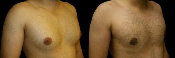 Gynecomastia Patient 3 Before & After Details