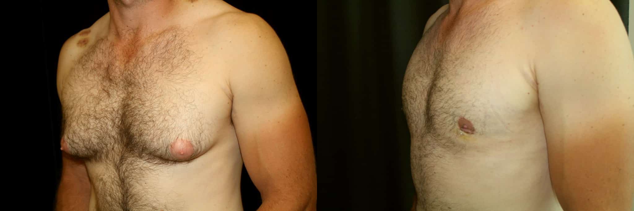 Gynecomastia Patient 2 Before & After Details