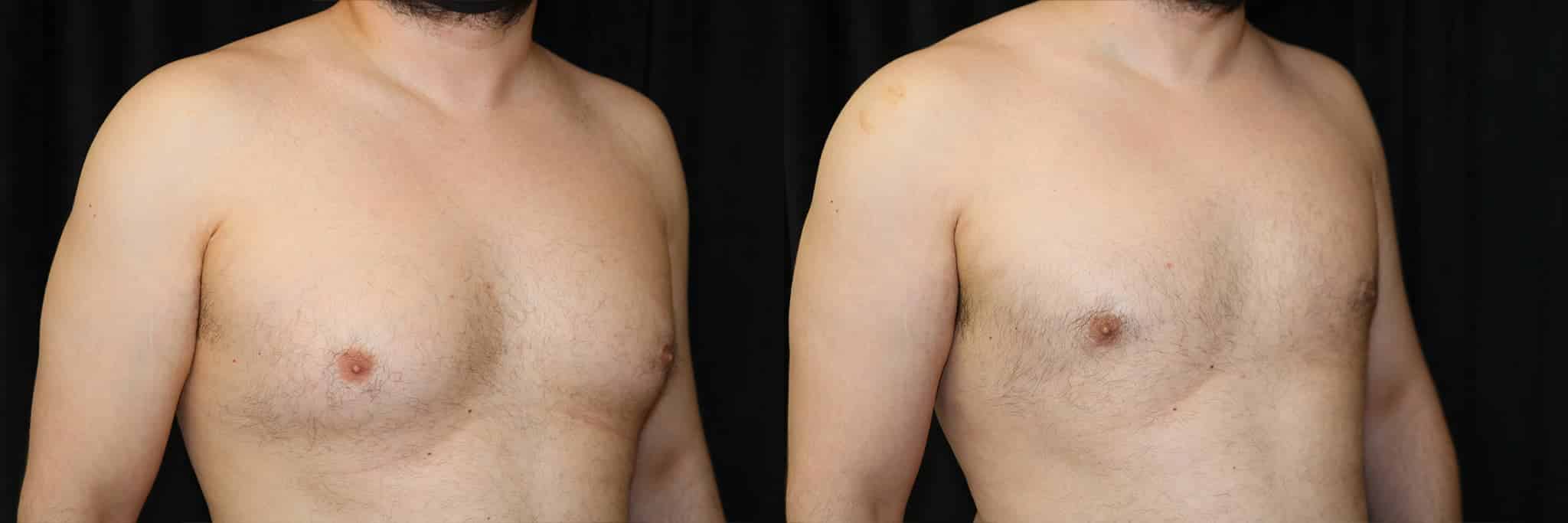 Gynecomastia Patient 3 Before & After Details