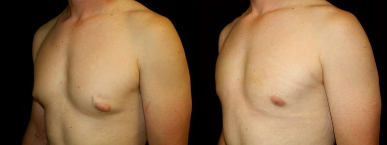 Gynecomastia Patient 4 Before & After Details