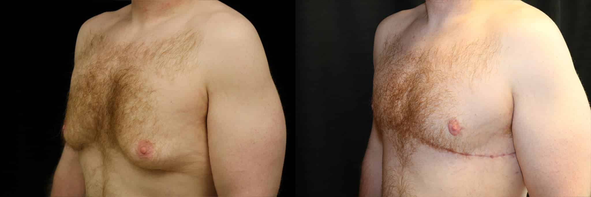 Gynecomastia Patient 5 Before & After Details