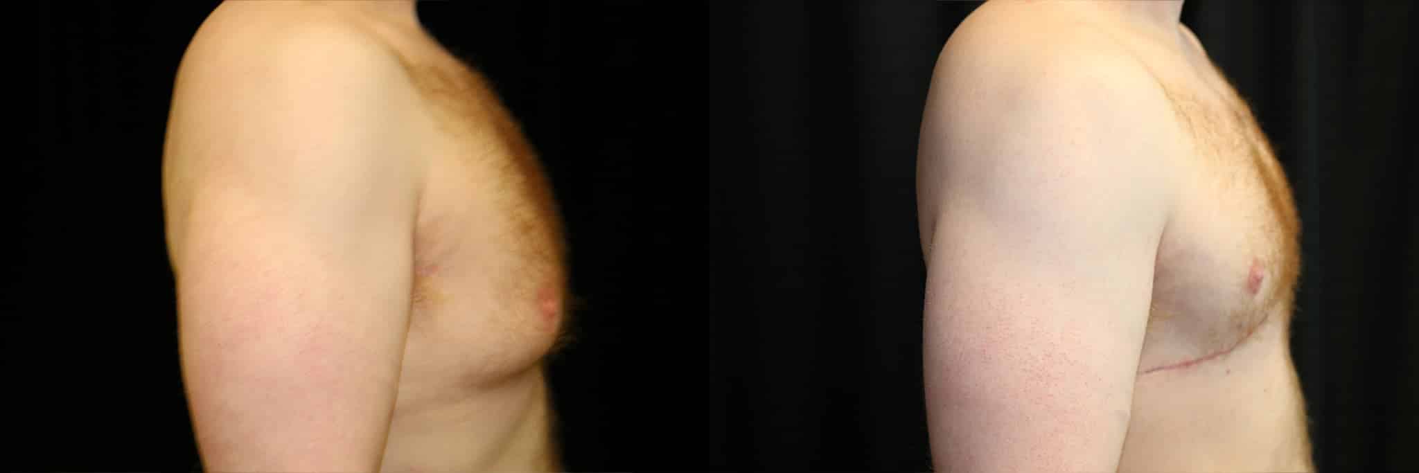 Gynecomastia Patient 5 Before & After Details