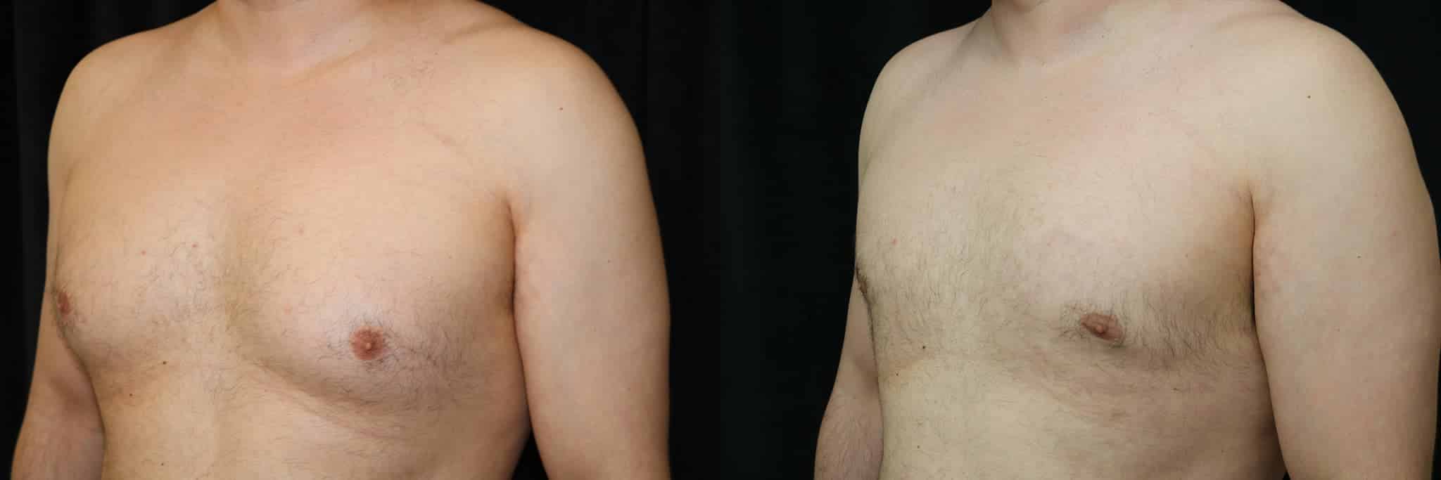 Gynecomastia Patient 3 Before & After Details