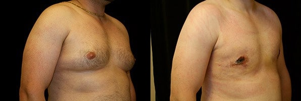 Gynecomastia Patient 10 Before & After Details