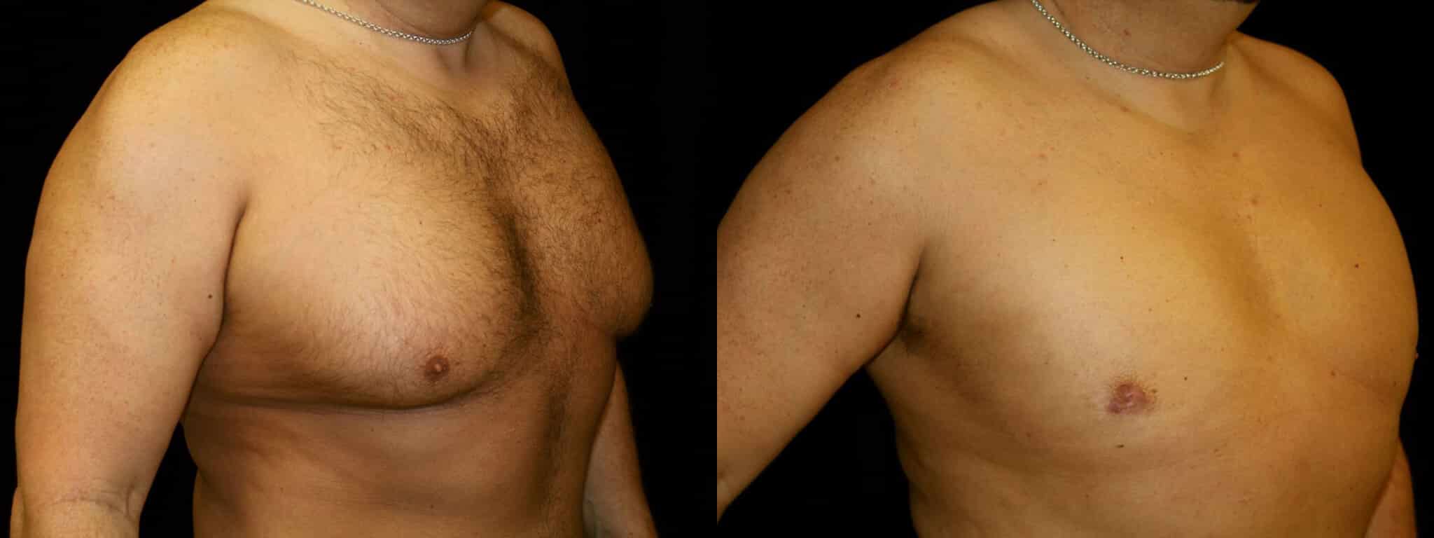 Gynecomastia Patient 19 Before & After Details