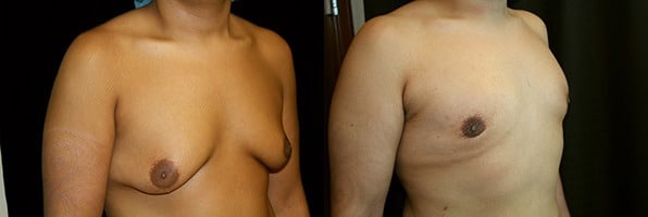 Gynecomastia Patient 12 Before & After Details