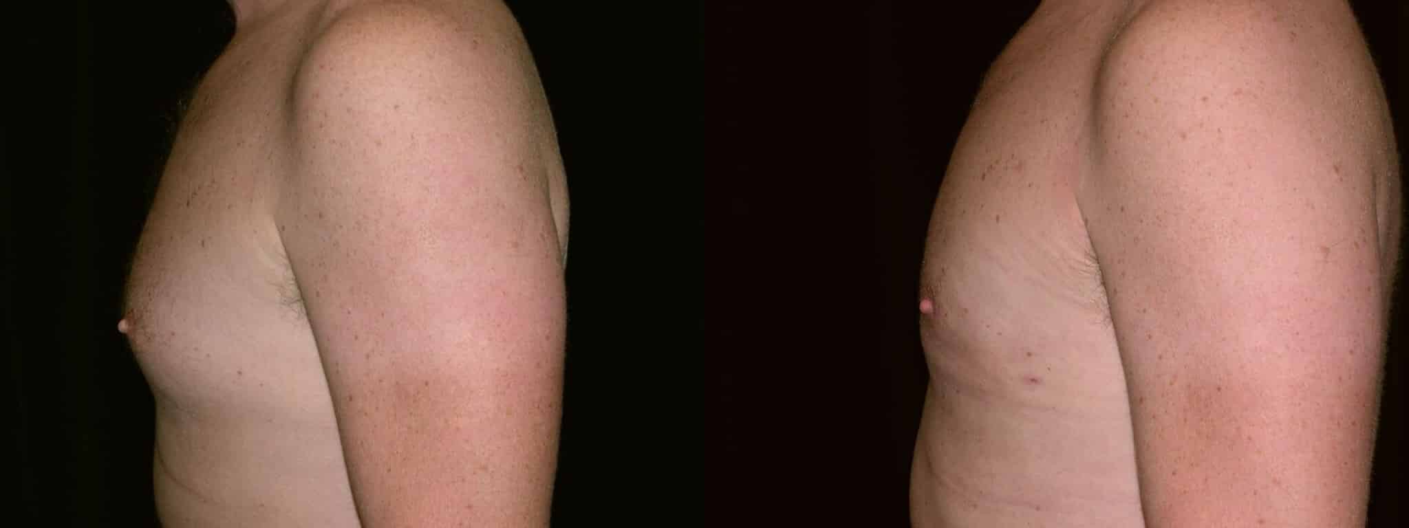 Gynecomastia Patient 8 Before & After Details