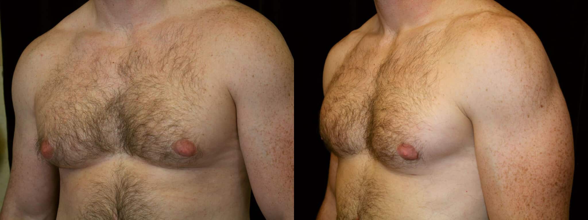 Gynecomastia Patient 8 Before & After Details