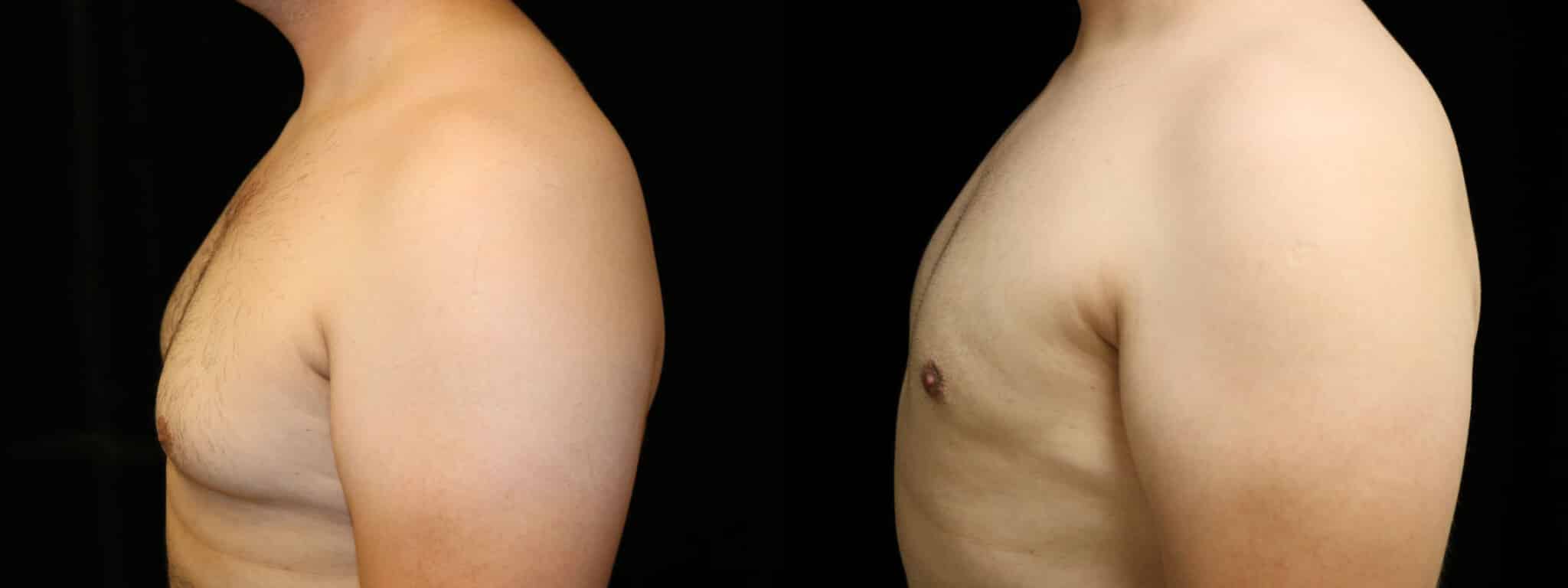 Gynecomastia Patient 1 Before & After Details