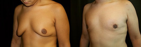 Gynecomastia Patient 12 Before & After Details