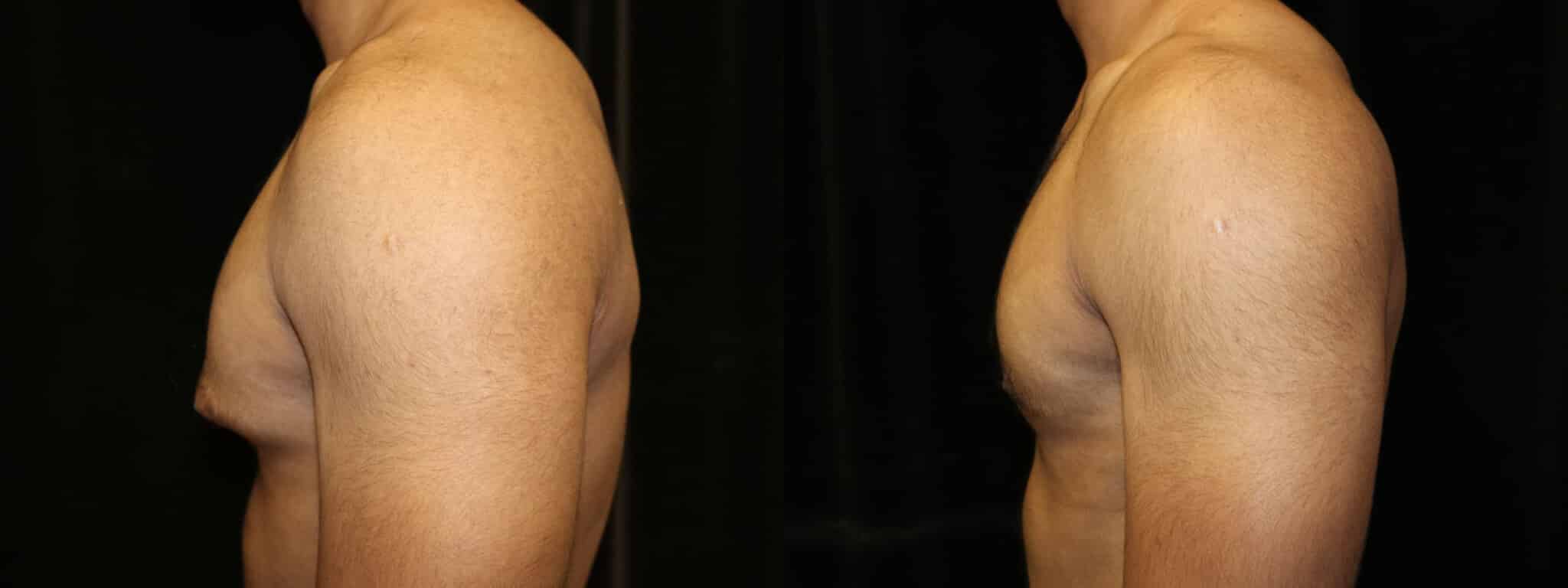 Gynecomastia Patient 2 Before & After Details