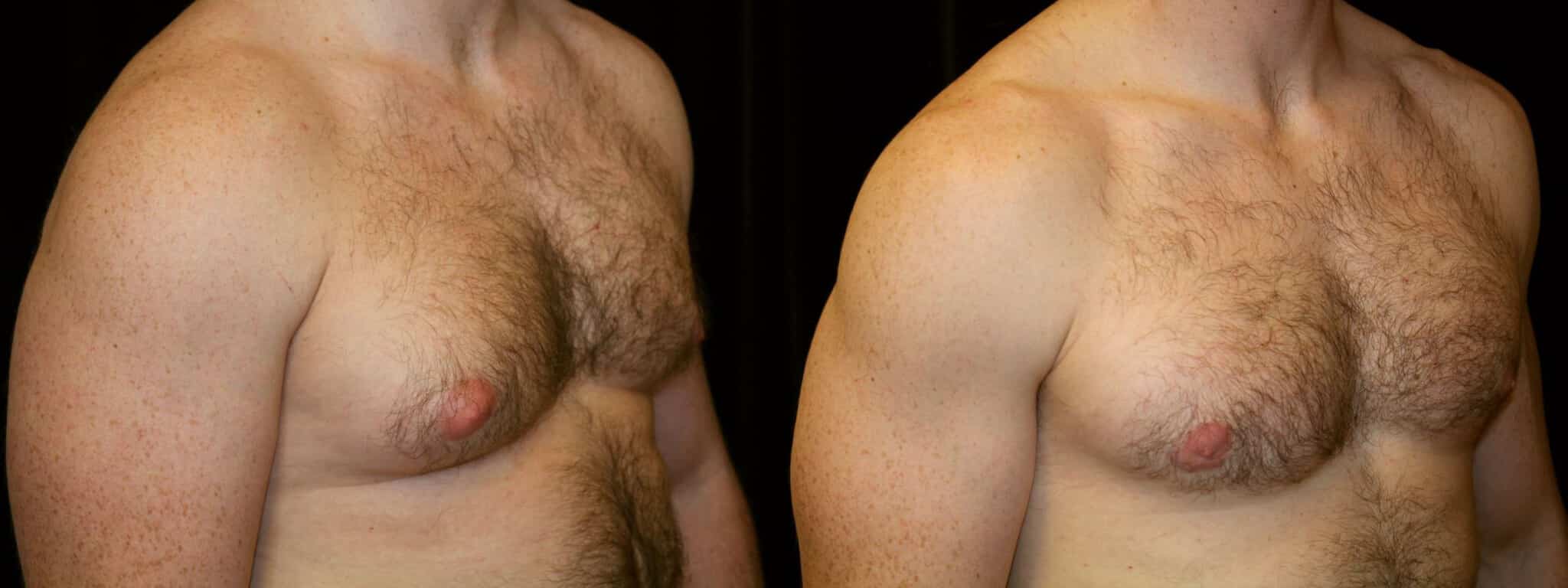 Gynecomastia Patient 8 Before & After Details