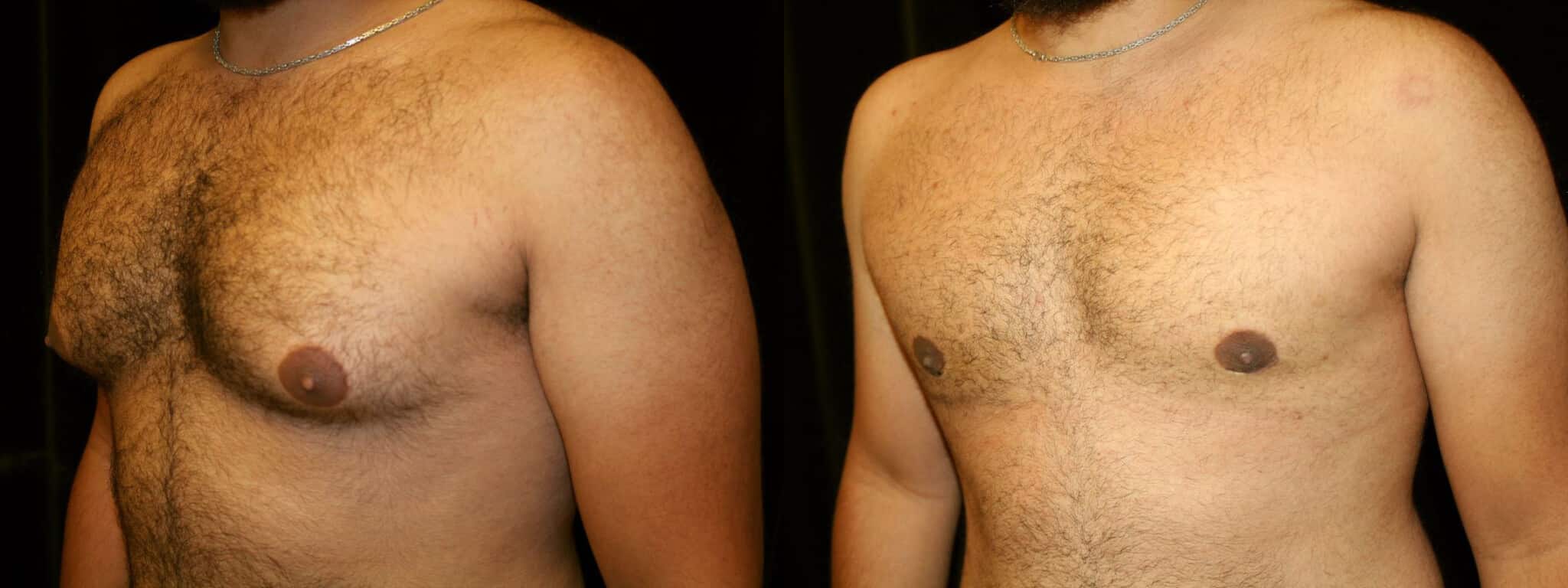 Gynecomastia Patient 20 Before & After Details