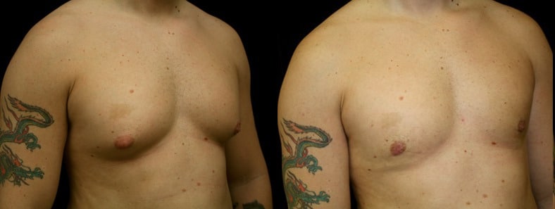 Gynecomastia Patient 15 Before & After Details