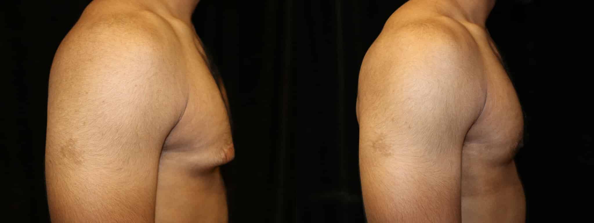 Gynecomastia Patient 2 Before & After Details