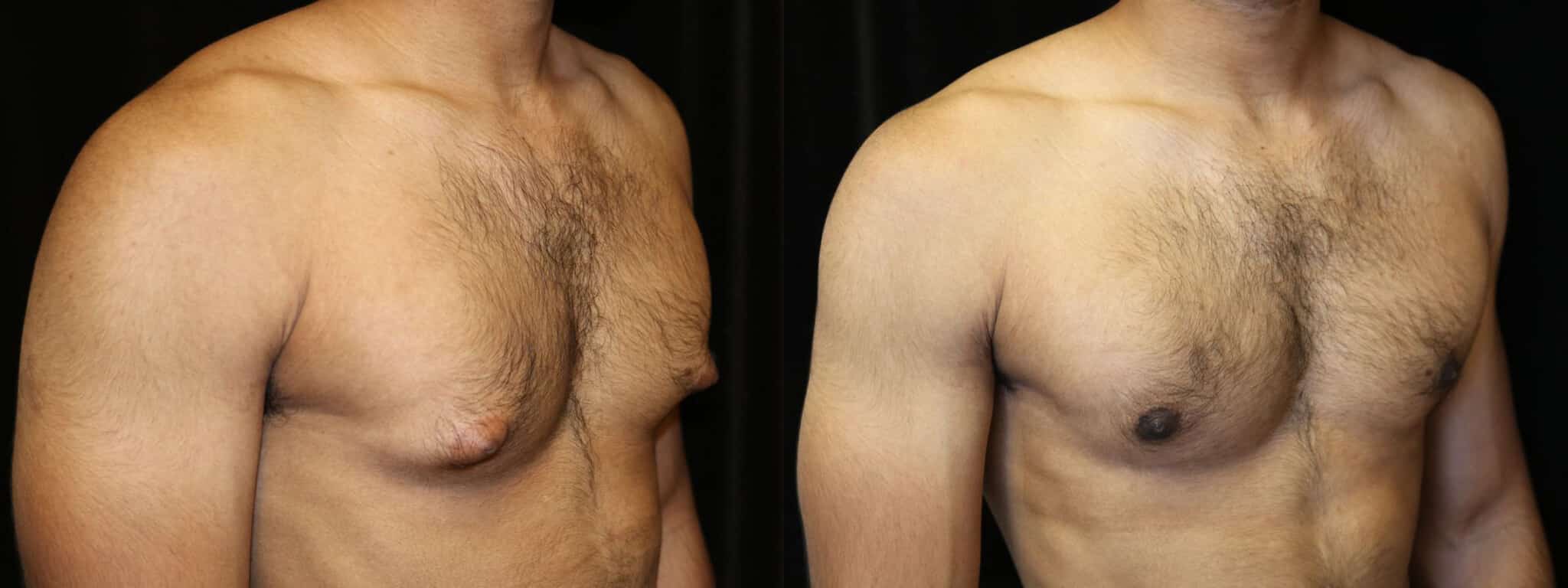 Gynecomastia Patient 2 Before & After Details